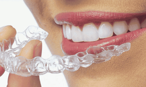 Aligners-1